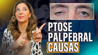 Entendendo as Causas da Ptose Palpebral [upl. by Engracia437]