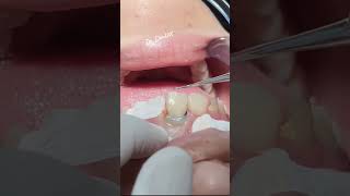 Class IV composit Restoration dentist dentistry tooth satisfying dentaltreatment [upl. by Juta]