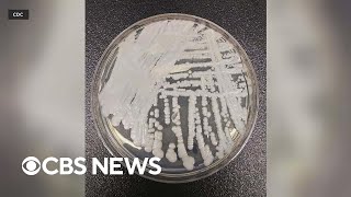 CDC issues warning about a fungus called Candida auris [upl. by Odarnoc]