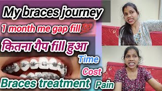 braces vlog🦷getting braces vlog braces treatment bracestreatment braces bracesupdate [upl. by Giuditta321]