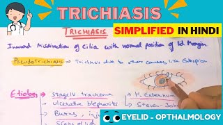 Trichiasis  Hindi  Opthalmology [upl. by Roch]