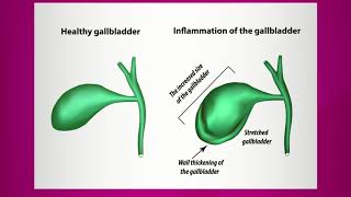 Pain Caused by Gallbladder Inflammation [upl. by Namurt]