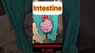 Intussusception l Intestine l dr Umar khan [upl. by Loginov]