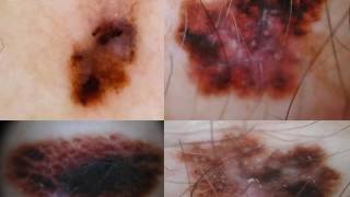 DERMATOSCOPIA DEL MELANOMA EXTENSIVO  Dra Virginia Gonzalez [upl. by Cargian178]