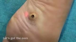 Corn Removal Laser Treatment at HLCCS RANCHI Call now  9334334935 corns callus footcare [upl. by Sanburn]