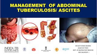 Management of Abdominal TB  Tubercular AscitesIntestinal TB [upl. by Ilac]