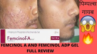 Femcinol A and Femcinol ADP gel full Review best gels for Acne get rid of pimples now [upl. by Harwill]