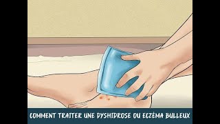 Comment traiter une dyshidrose ou eczéma bulleux [upl. by Reamy]