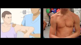 Shoulder Dislocation Reduction Technique  How to reduce Shoulder Dislocation [upl. by Hgierb]