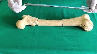 Management of infected nonunion femur by antibiotic coated nail [upl. by Latona]