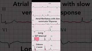 Hypothermia ECG [upl. by Oirazan]