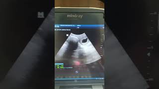 Blighted ovum Ultrasound ultrasound shortvideo [upl. by Arch]