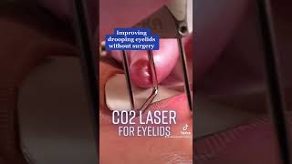 How to Rejuvenate Your Eyes  CO2 Laser Treatment [upl. by Biagio798]