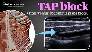 Ultrasound Guided Transversus Abdominis Plane TAP Block [upl. by Reivaj]