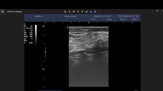 Arterial stenosis by atheromatous plaque [upl. by Nonnerb]