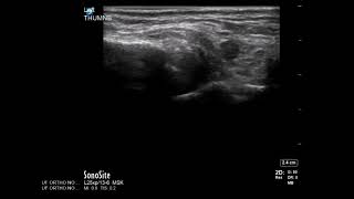 Thumb Ultrasound Carpometacarpal CMC Joint Injection [upl. by Aan]