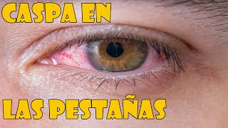 Caspa en las pestañas o blefaritis  síntomas y tratamiento [upl. by Ahsote71]