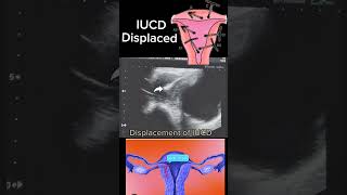 Displaced IUCD Causes Diagnosis and Management shortsbeta yt healthytips DrSaimakhan [upl. by Sosthenna]