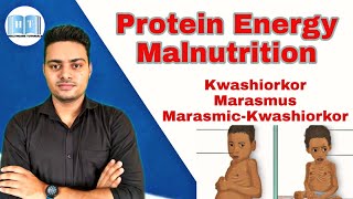 Protein Energy Malnutrition  Kwashiorkor Vs Marasmus [upl. by Solberg702]