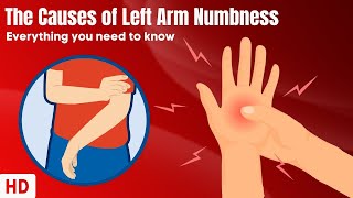 The Causes Of Left Arm Numbness [upl. by Yennek923]