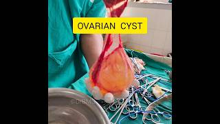 Ovarian Cyst ovariancancer ovaries cyst cancer gynaecology obstetricsandgynecology shorts [upl. by Raines]