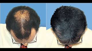 Hair Loss How To Regrow Hair Naturally Before and After Photos [upl. by Crosby]