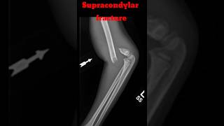 Supracondylar Fracture shorts fracture supracondylarfracture elbowxray radiology [upl. by Kaufmann331]