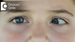 Can Exotropia be cured with eye drops or medicines  Dr Sirish Nelivigi [upl. by Jacquenette232]