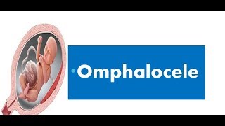 Omphalocele [upl. by Thomajan]