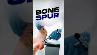 How Arthritis Leads to Cartilage Wear Bone Spurs and Joint Calcification [upl. by Arella]