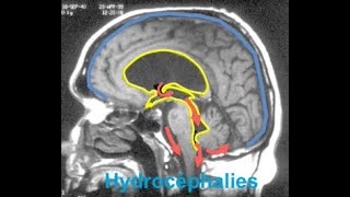 Les hydrocéphalies [upl. by Leveridge]