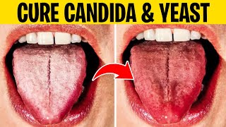 Cure Candida Overgrowth amp Yeast Infections Permanently With These 8 Remedies [upl. by Ohaus]