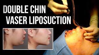 Submental Chin VASER Liposuction Under Local Anesthesia  Dr Wang  West End Plastic Surgery [upl. by Rasure590]