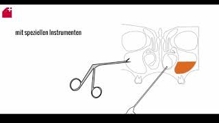 Nasennebenhöhlen OP  FESS  chronische Sinusitis [upl. by Luby]