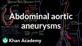 Abdominal aortic aneurysms  Circulatory System and Disease  NCLEXRN  Khan Academy [upl. by Midis]