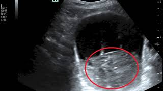 Bladder Hematoma US Annotated JETem 2019 [upl. by Bowrah]