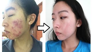 How I Cleared My Acne with ONE Product NO ACCUTANE [upl. by Zigrang]