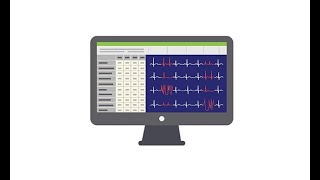 Reviewing the ECG of the Holter monitor [upl. by Adao]