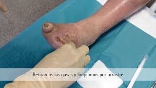 Prontosan® Solución y Askina® Calgitrol® Paste tratamiento más efectivo para las heridas infectadas [upl. by Neumark]