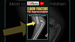 Elbow Fractures trauma nursing doctor [upl. by Mellitz16]