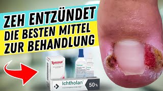 ZEH ENTZÜNDET So behandelst du ihn  Die besten Mittel gegen ENTZÜNDETE ZEHEN amp NAGELBETTENTZÜNDUNG [upl. by Katzman]