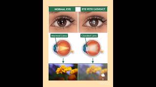 quotNormal vs Clouded Lens Key Differences Explainedquot NormalLens CloudedLens VisionHealth Healthy [upl. by Aikyt]