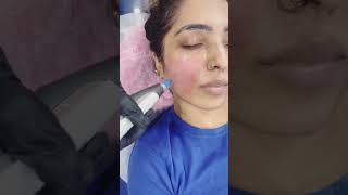 Dermapen Microneedling for acne scars  Dermalyn Aesthetics  Dr Muskan Tyagi  Call  9311691081 [upl. by Callery]