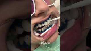 teeth whitening process 🦷 torontoteethwhitening teethwhitening [upl. by Rhtaeh]