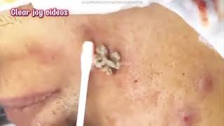 Big Cystic Acne Blackheads ExtractionBlackheads amp Milia Whiteheads Removal Pimple Popping [upl. by Westney923]