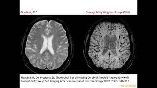 68 CAA Cerebral Amyloid micro Angiopathy vascular dementia micro bleeds superficial siderosis [upl. by Norahc]