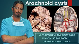 1 Arachnoid cysts Second Part [upl. by Asiak188]