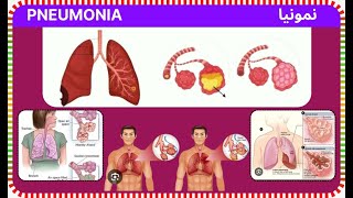 pneumonia  namonia  निमोनिया [upl. by Ramoj]