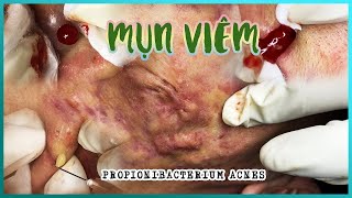 Big Cystic Acne Blackheads Extraction Blackheads amp Milia Whiteheads Removal Pimple Popping [upl. by Ilamad]