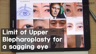 Limit of Upper Blepharoplasty for a sagging eye [upl. by Aerdnaz203]